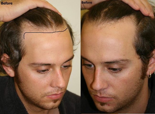 Hair Restoration Staten Island